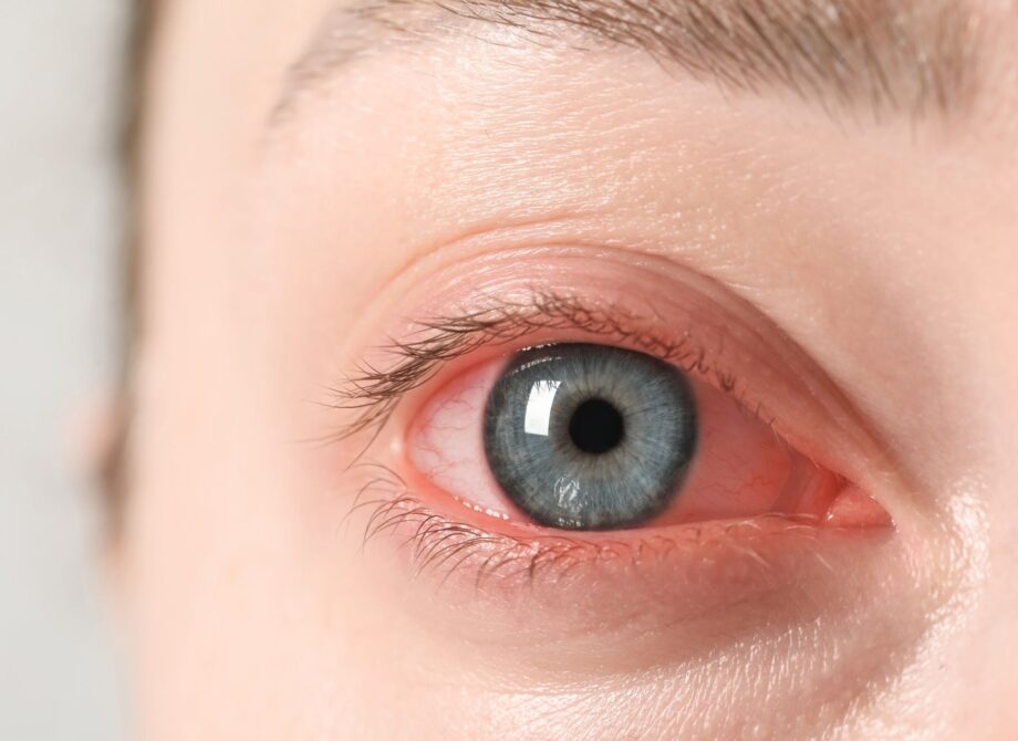 Przesuszone, zmęczone oczy? Jak sobie z tym radzić?